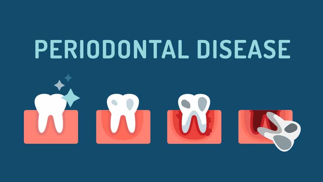 Periodontal disease