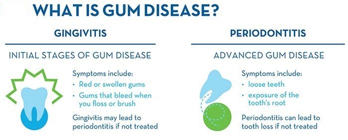 What is Gum Disease? Gingivitis and other periodontal diseases