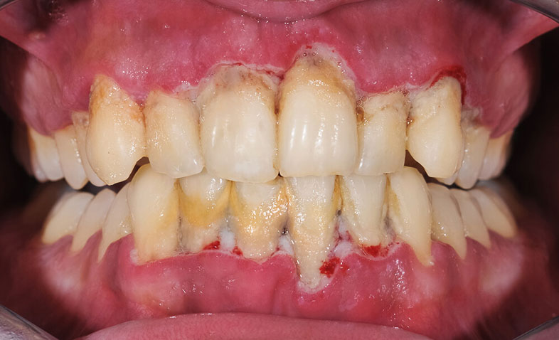 signs of gum disease