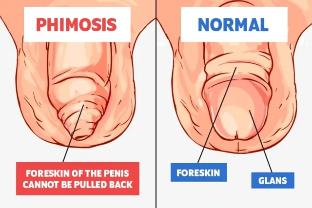 Understanding tight foreskin