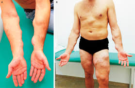 Lipomatosis