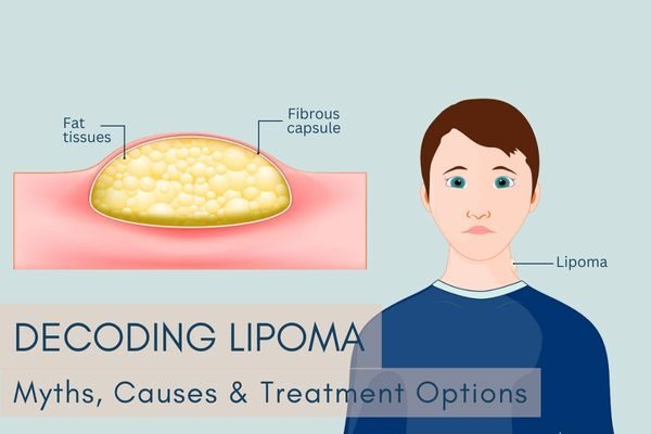 Lipomatosis: causes, symptoms, and treatment