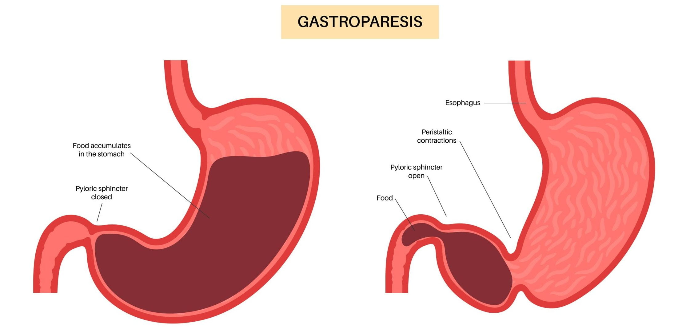 gastroparesis retatrutide Gastroparesis: Causes, Symptoms, and Treatment Approaches