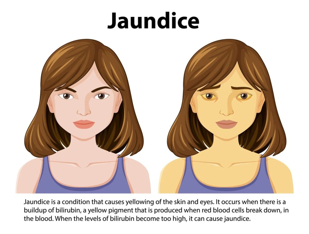 Jaundice