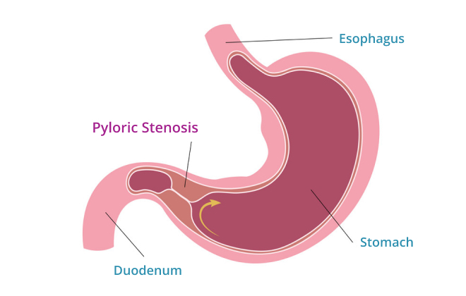 Stenosis