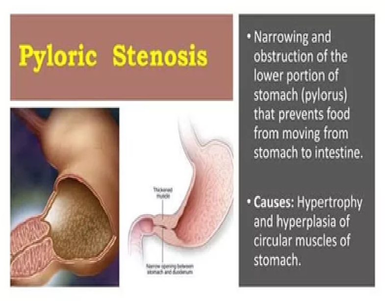 Pyloric Stenosis