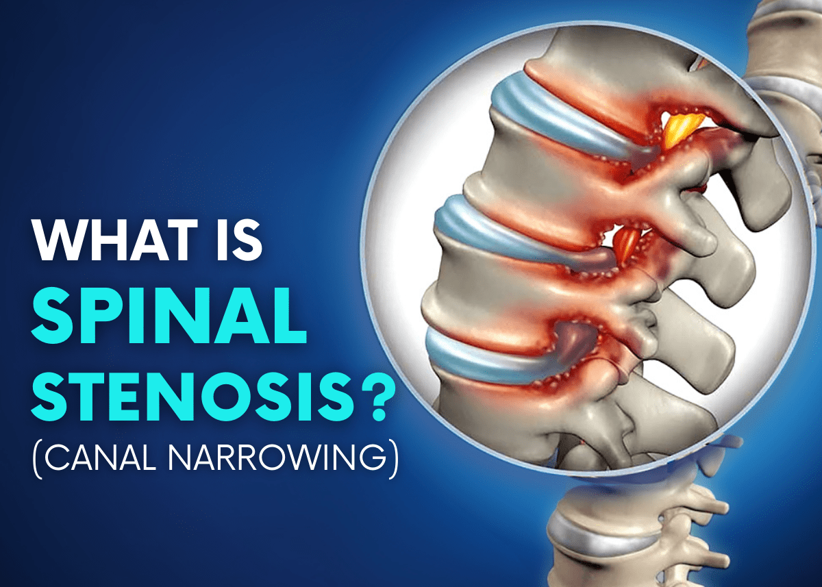 spinal stenosis - spinal canal narrowing