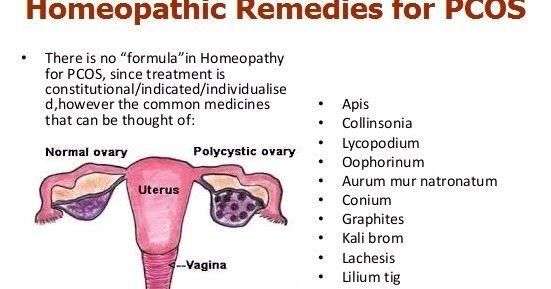 Homeopathy for Polycystic Ovarian Syndrome