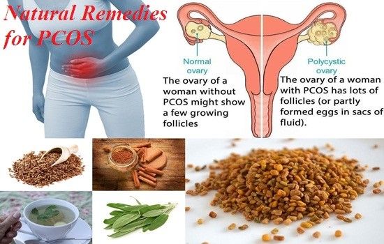 PCOS - Natural Treatments